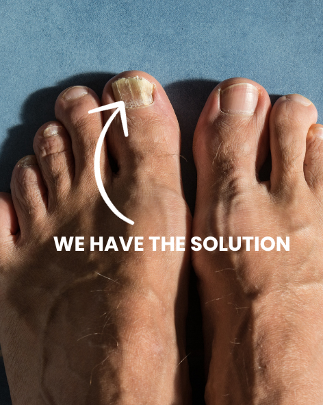 Bid Farewell to Toenail Fungus from the Comfort of Your Home